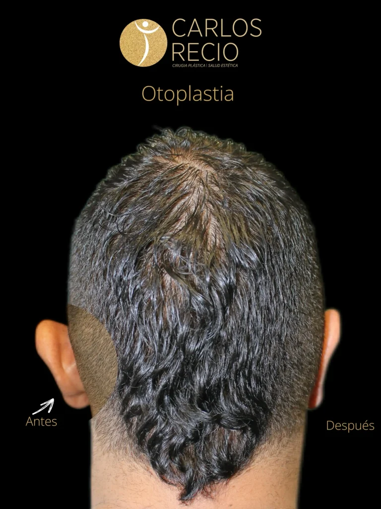 Otoplastia: qué es la cirugía de orejas, a qué edad se puede hacer y cómo es el proceso Otoplastia: qué es la cirugía de orejas, a qué edad se puede hacer y cómo es el proceso